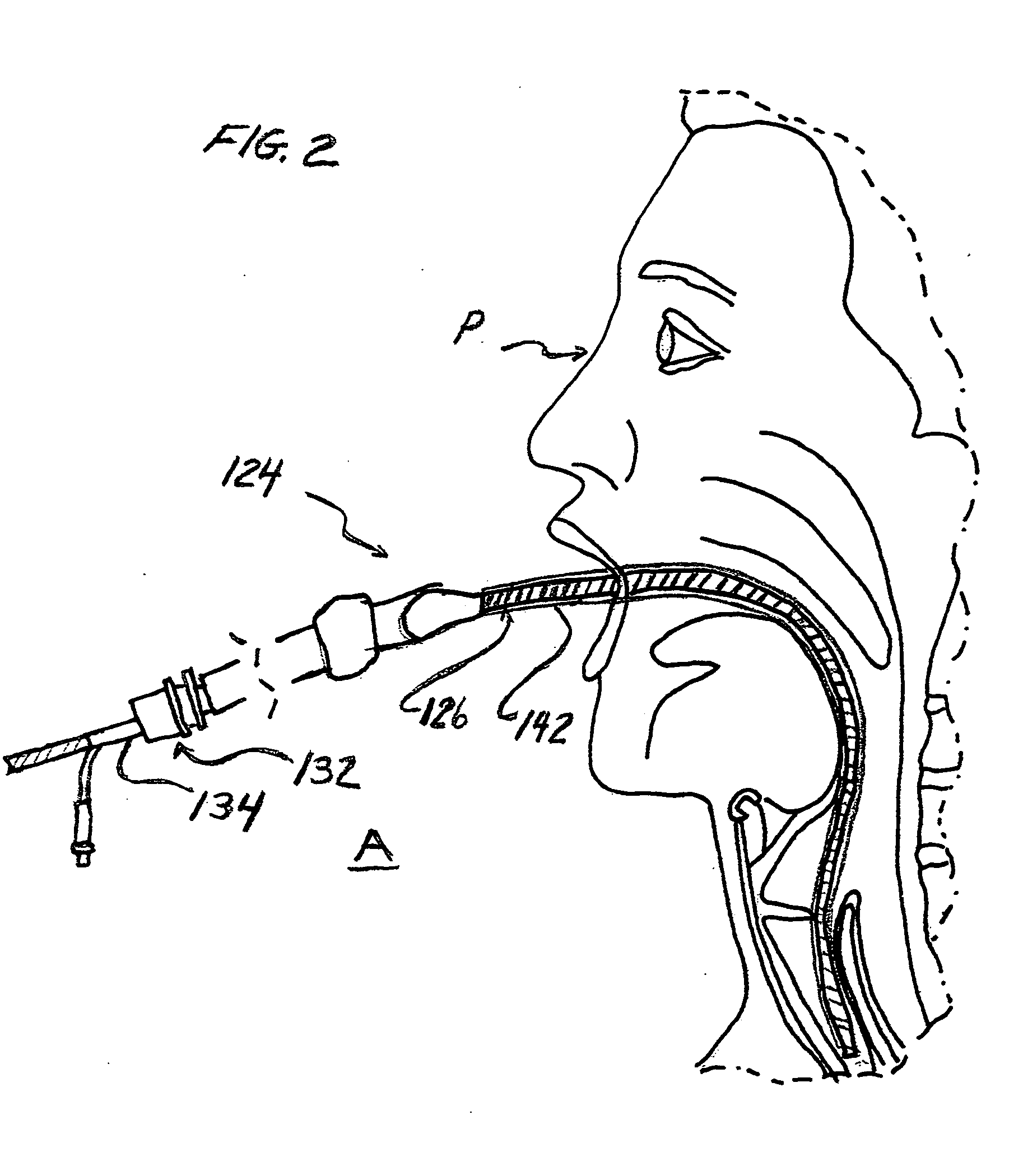 Method and device for placing an endotracheal tube