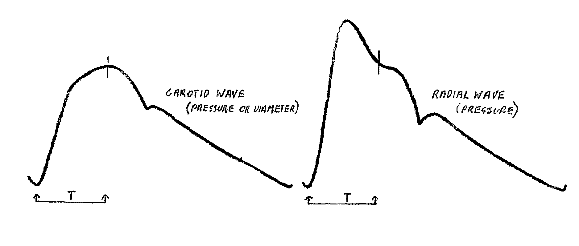 Method and apparatus for determination of central aortic pressure