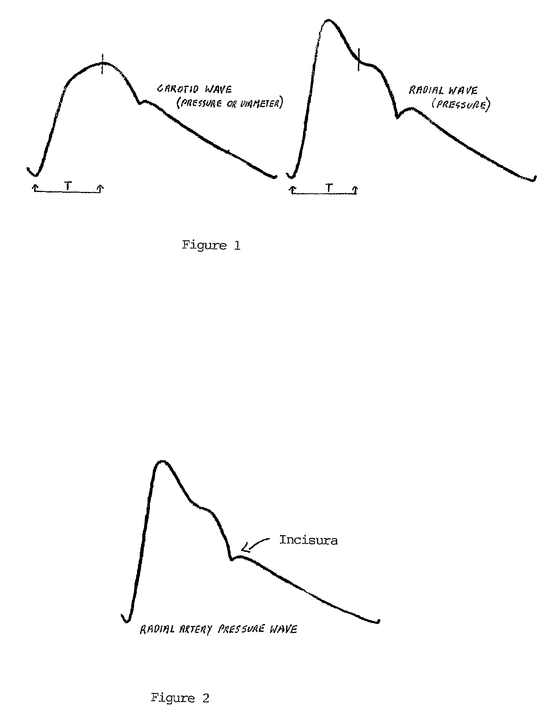 Method and apparatus for determination of central aortic pressure