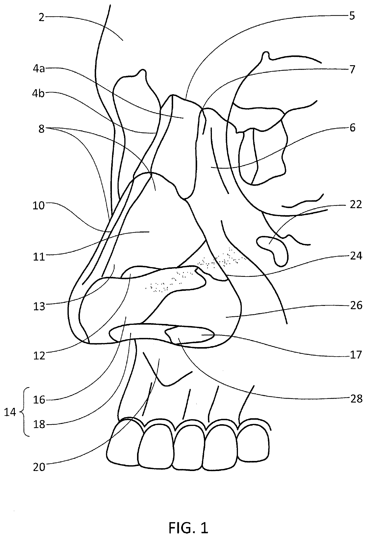 Nasal Implants and Methods of Use