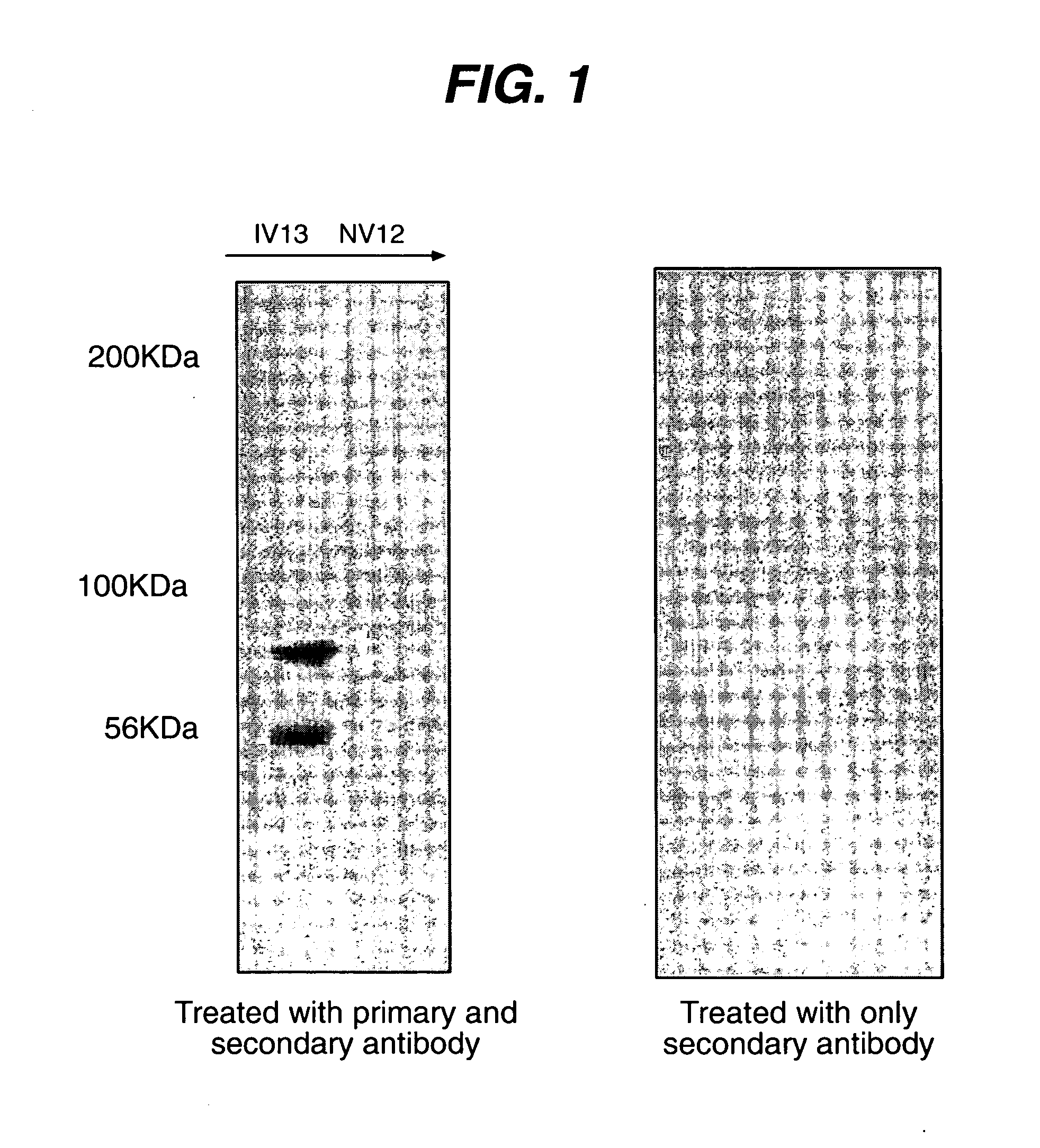 Diagnosis and prognosis of wound infection by measurement of a phospholipase a2 in wound fluid