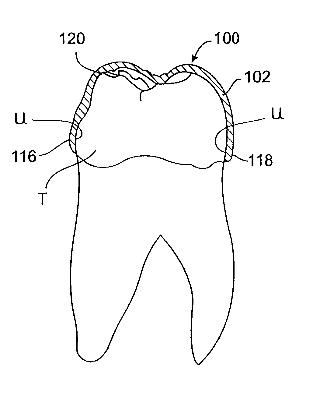 System and method for releasing tooth positioning appliances