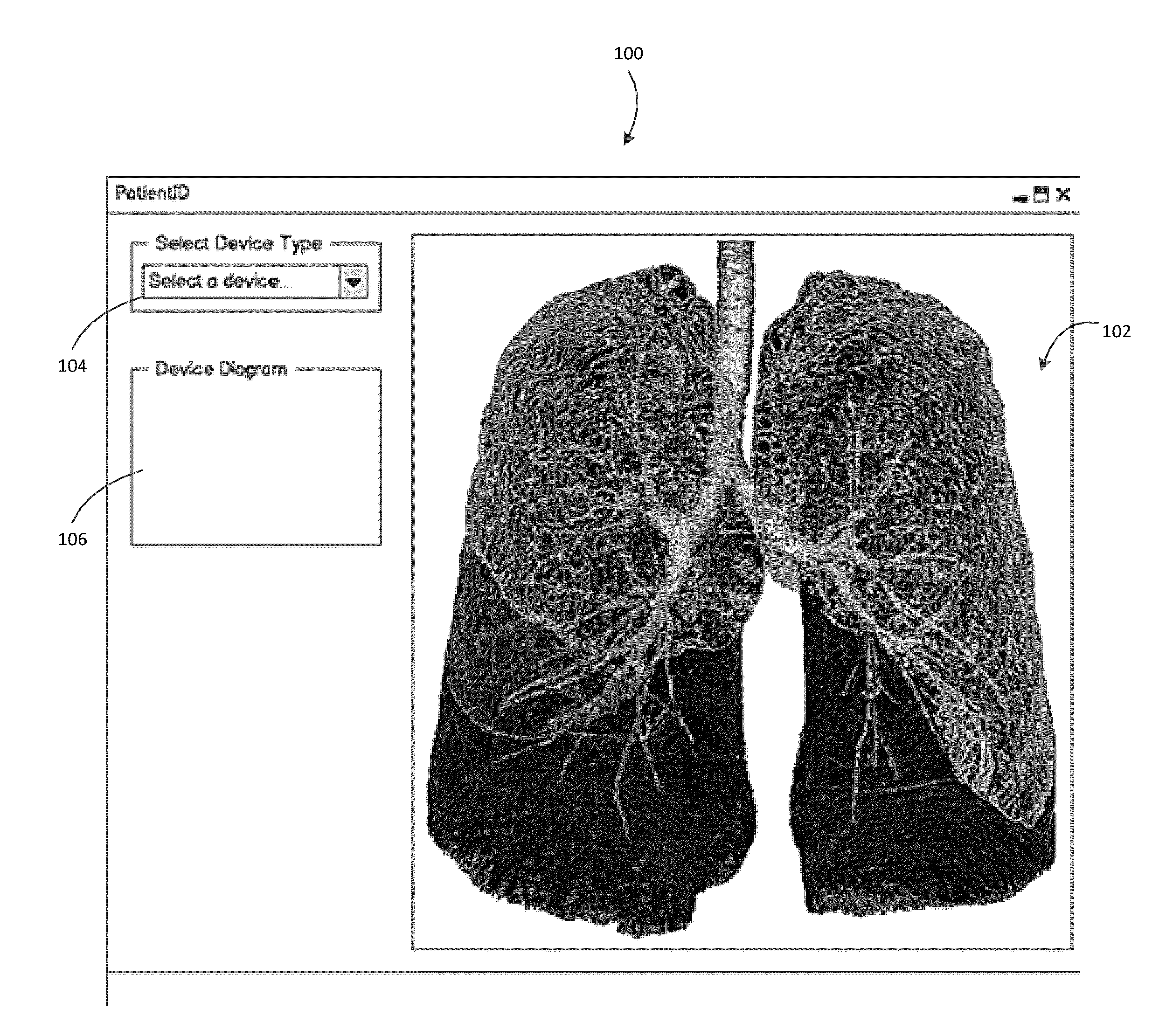 Treatment planning for lung volume reduction procedures