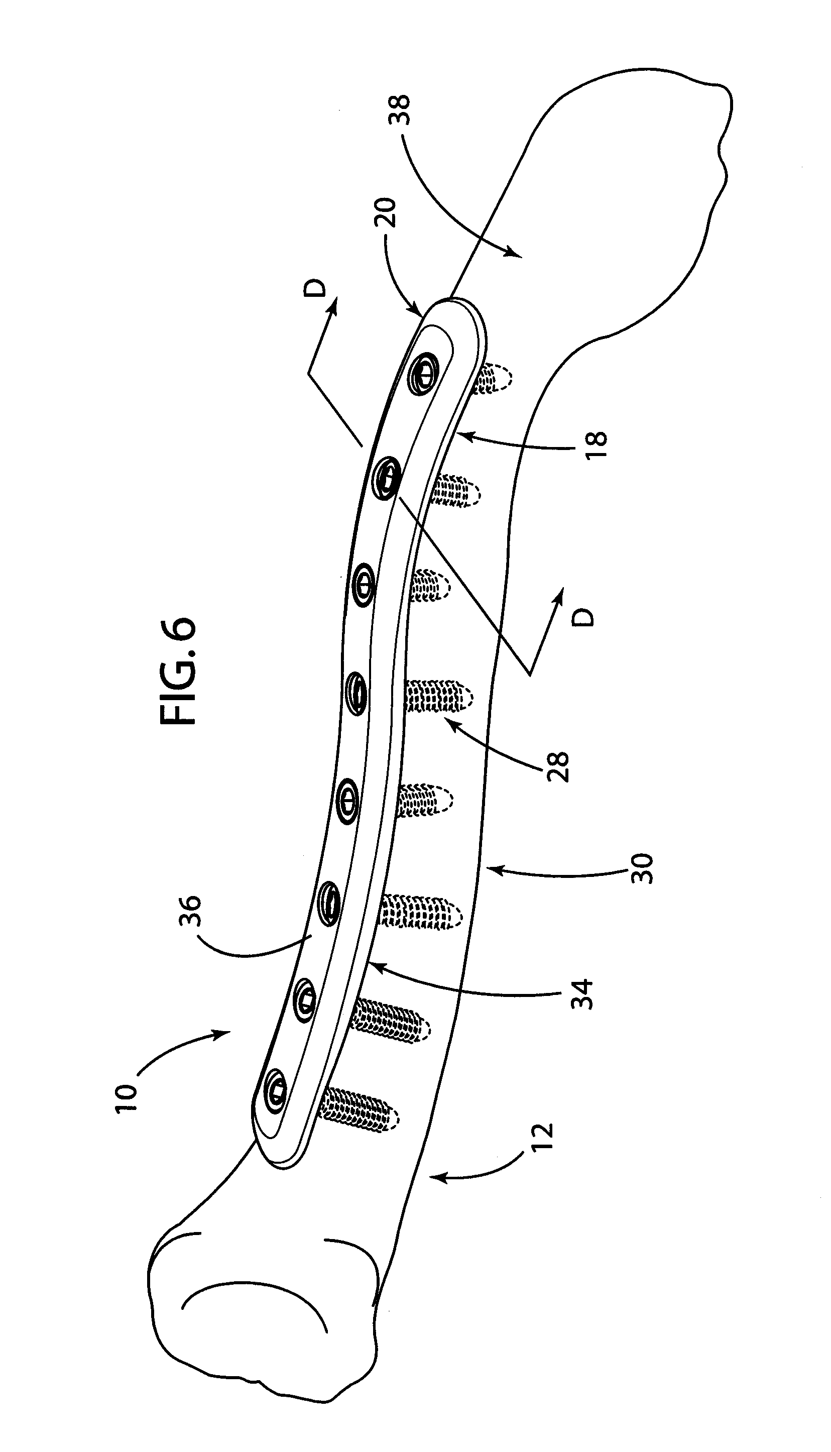 Clavicle Bone Plate