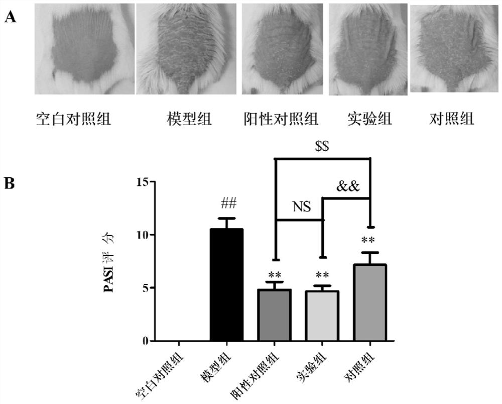 Traditional Chinese medicine composition for treating psoriasis