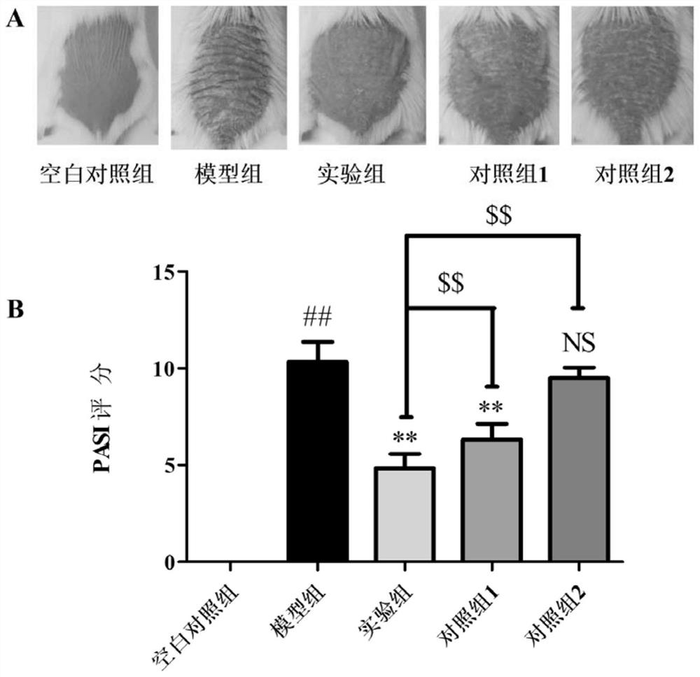 Traditional Chinese medicine composition for treating psoriasis