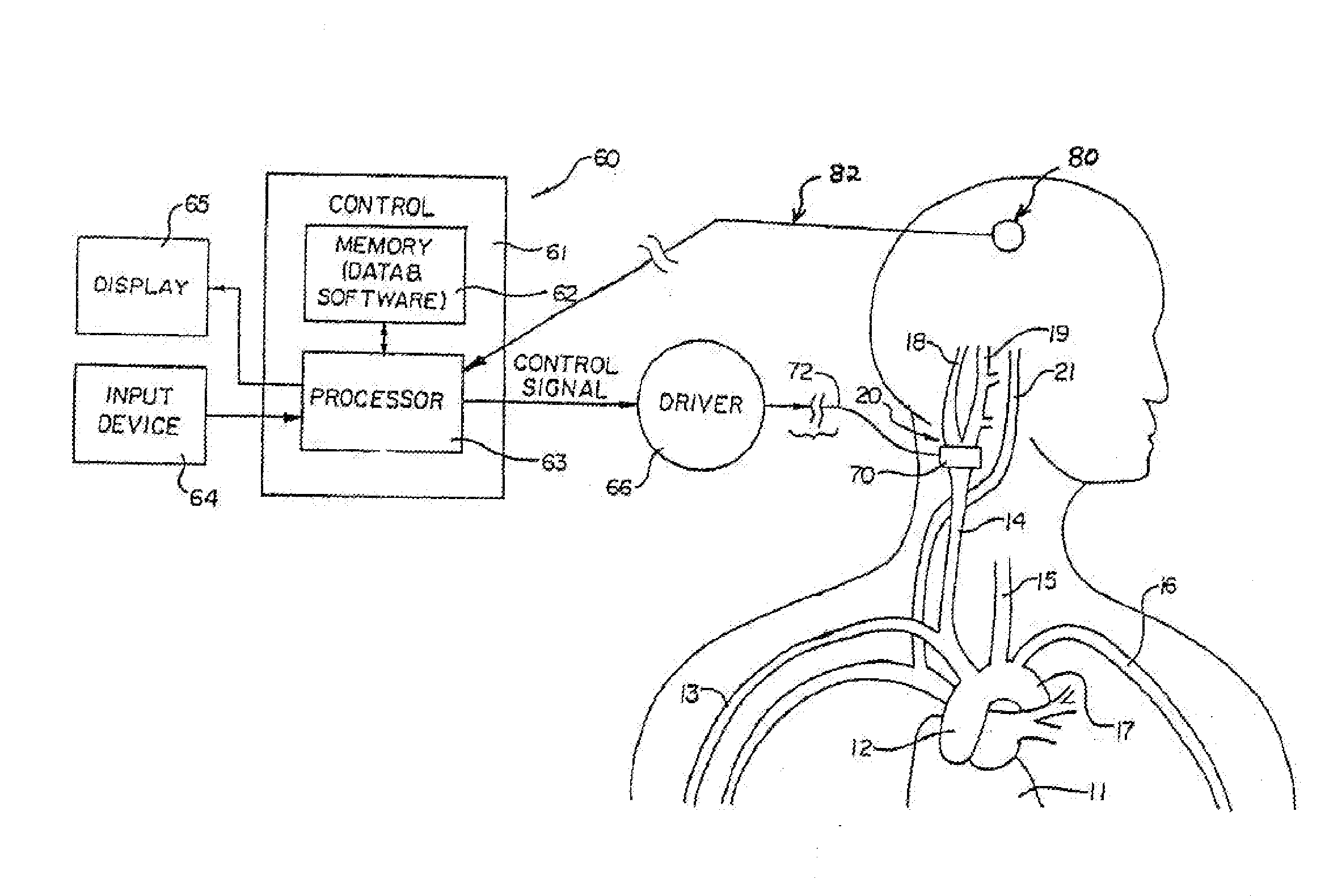 Baroreflex activation for pain control, sedation and sleep