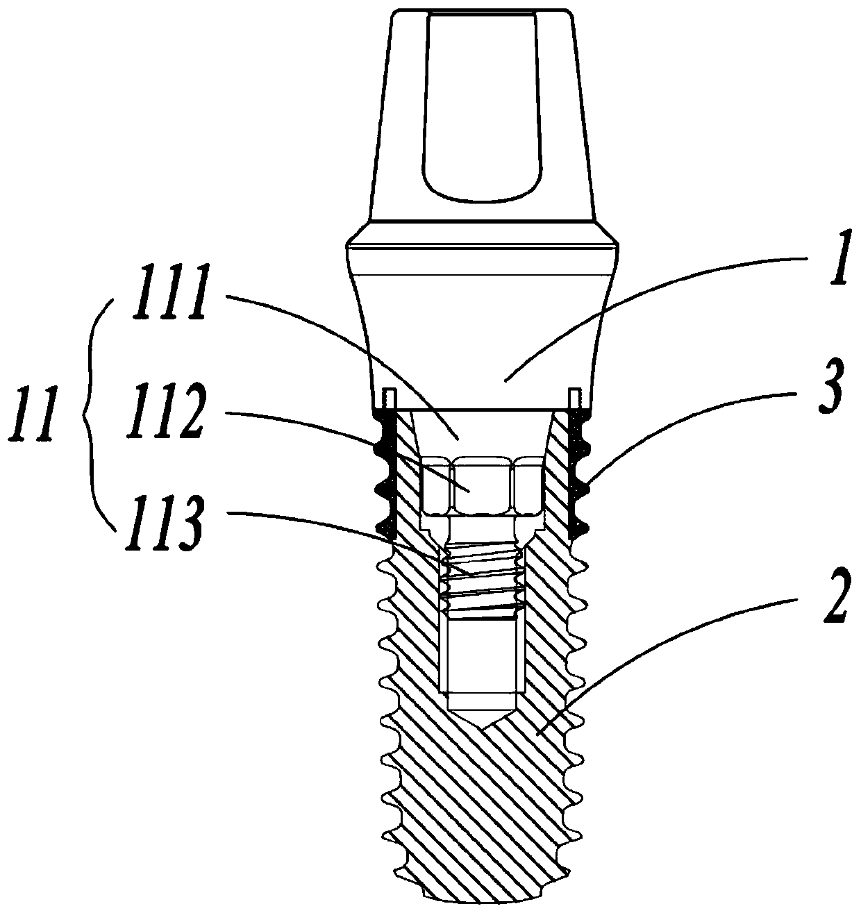 Dental implant system