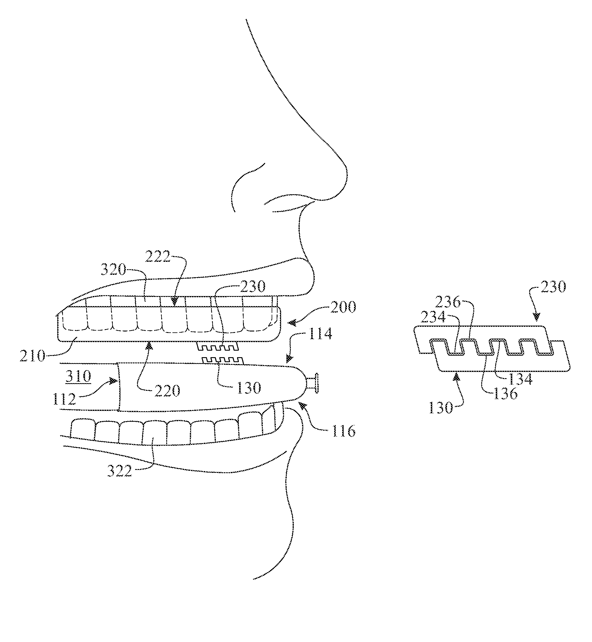 Oral device for treating sleep apnea