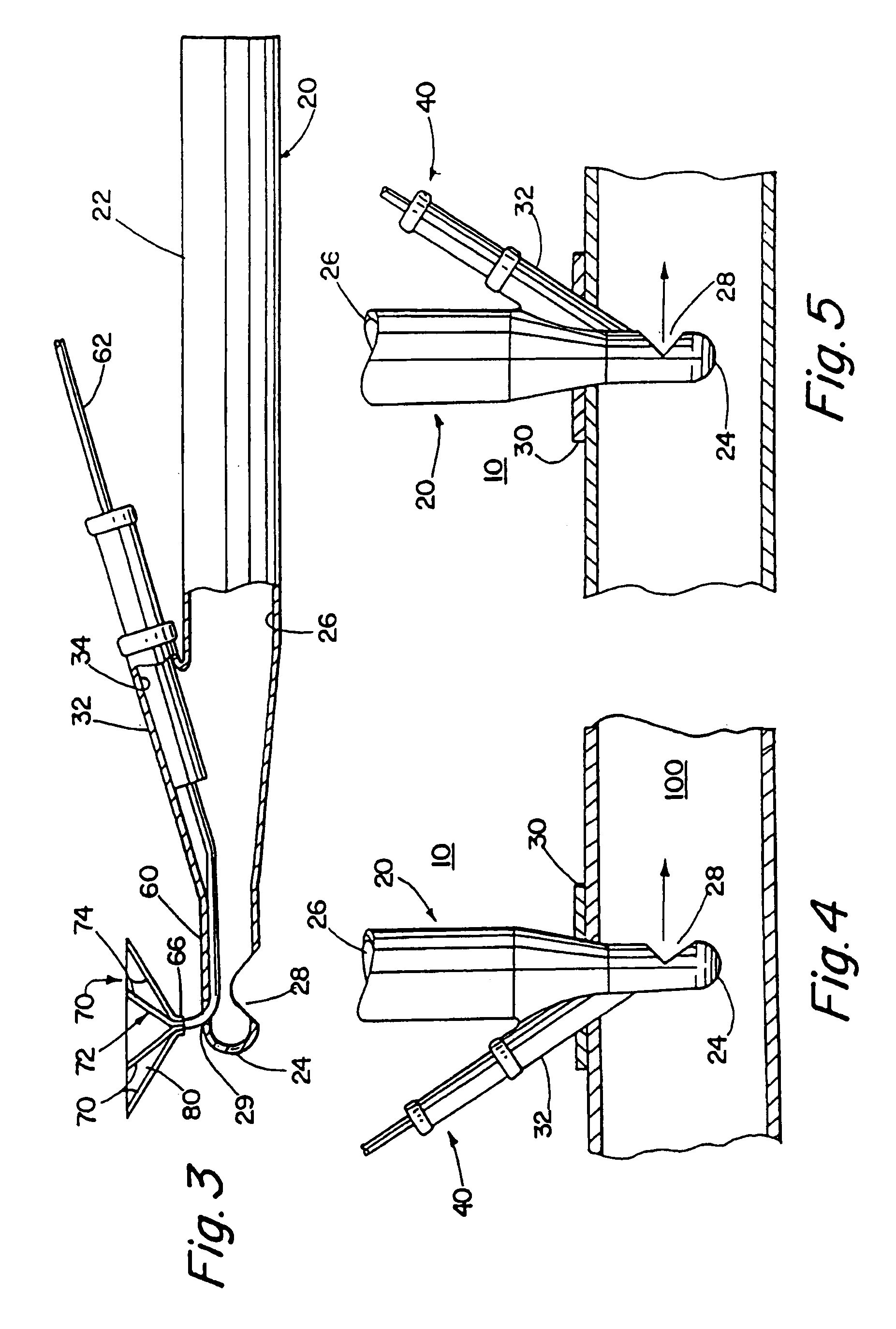 Adjustable blood filtration device