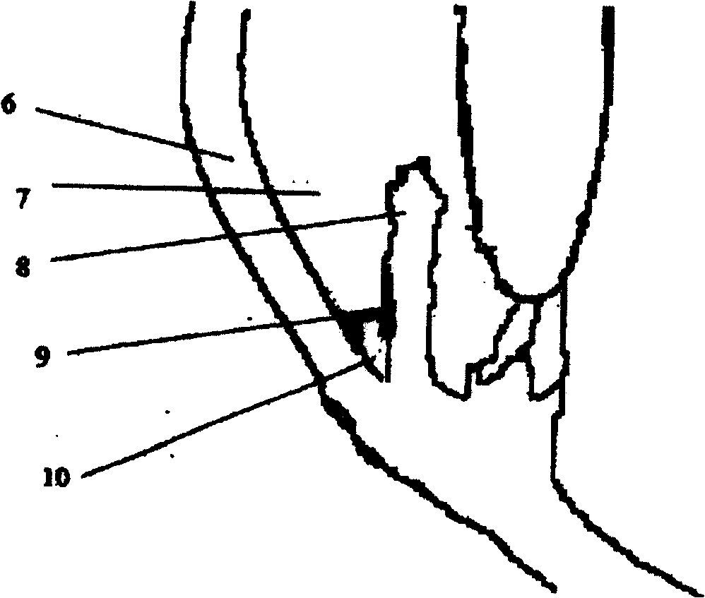 Expanding ring for treating glaucoma