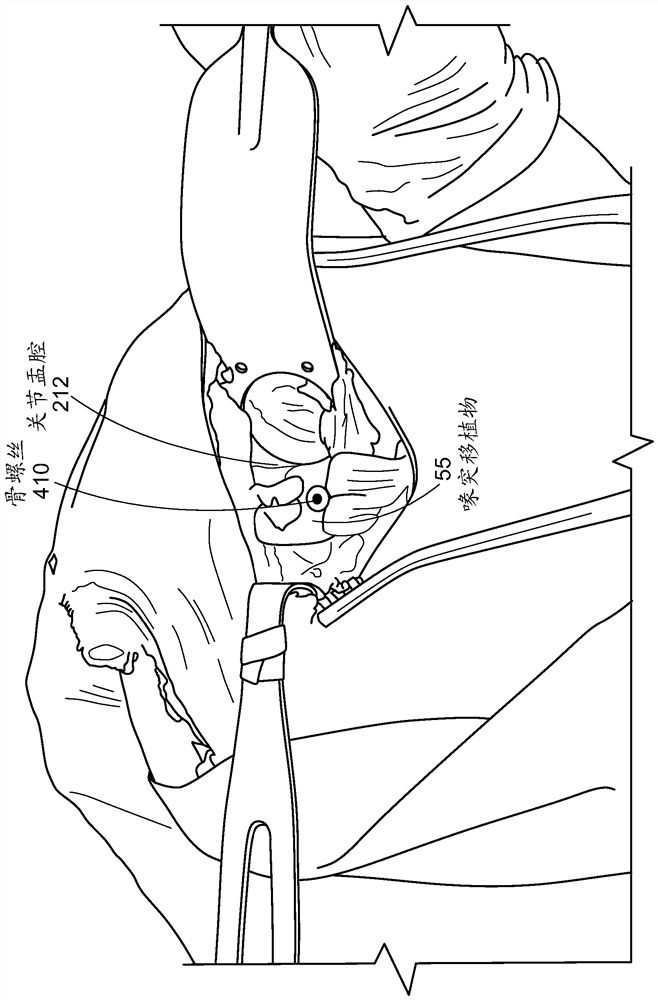 Open latarjet procedure for correction of anterior inferior glenoid bone loss