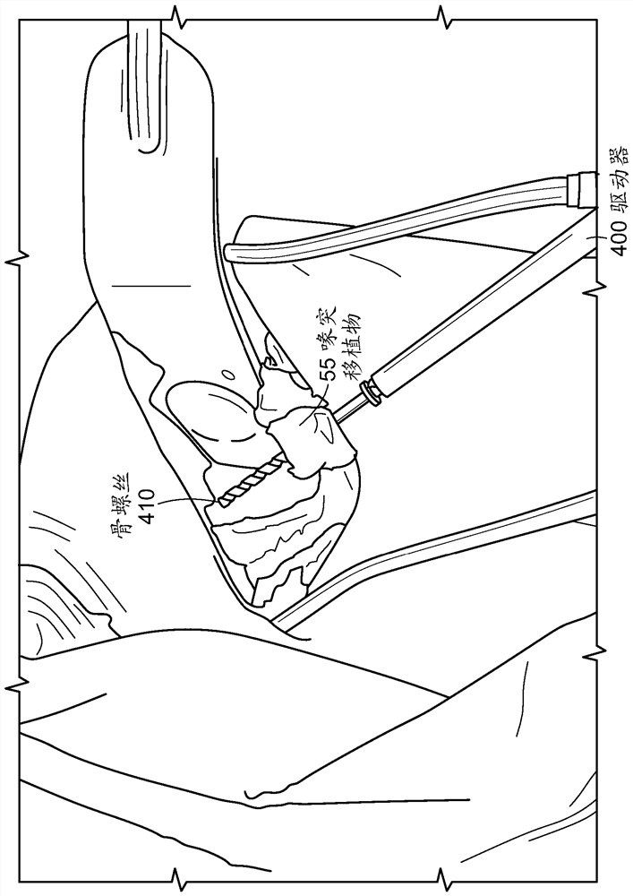 Open latarjet procedure for correction of anterior inferior glenoid bone loss