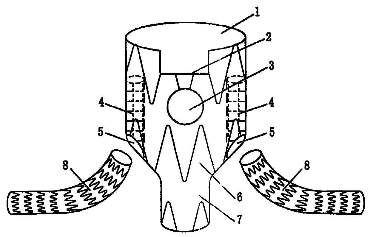 Stent-type blood vessel for intracavity treatment of complex abdominal aortic aneurysm