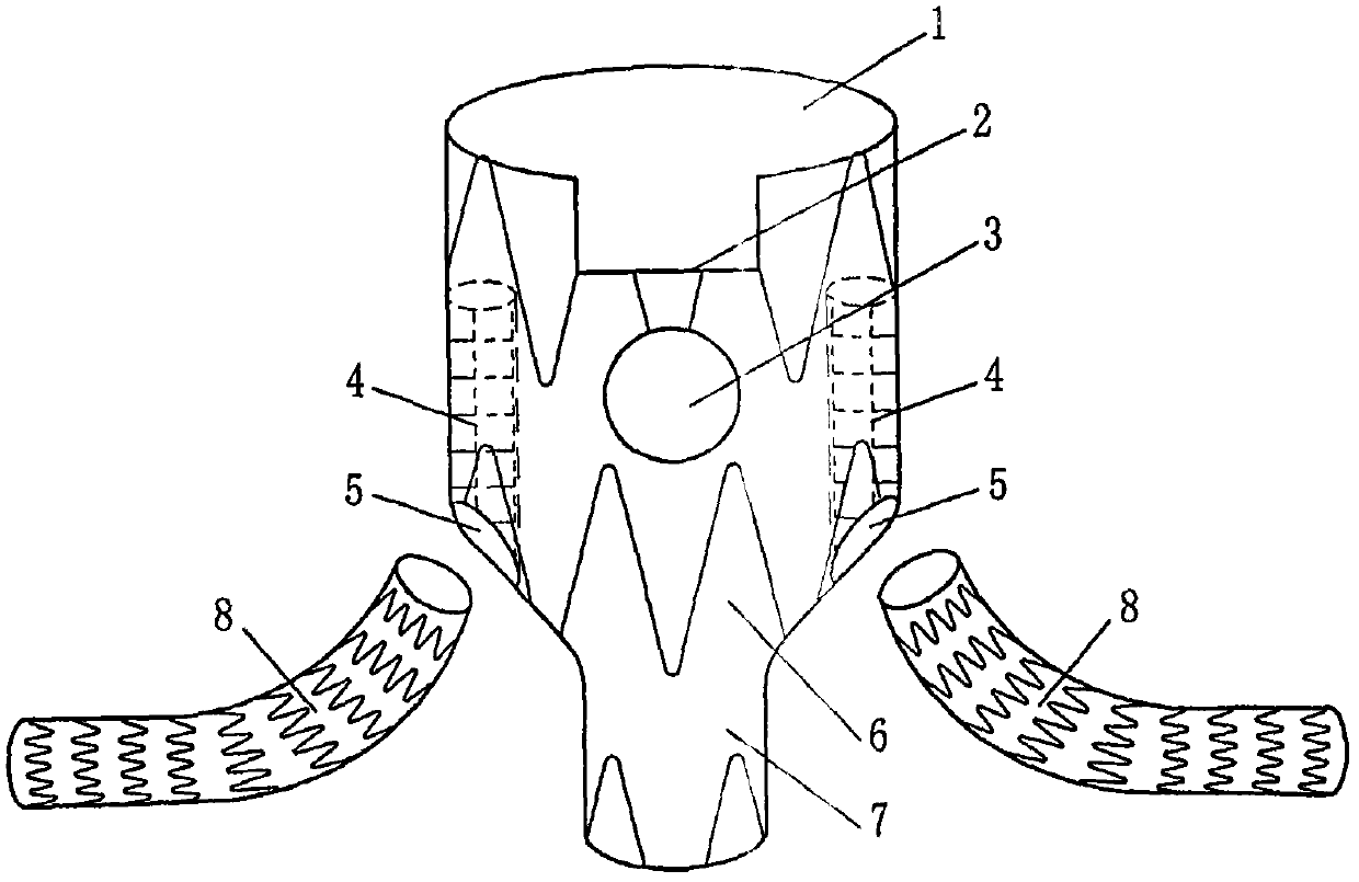 Stent-type blood vessel for intracavity treatment of complex abdominal aortic aneurysm