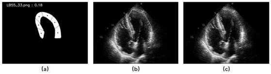 Ultrasonocardiogram myocardial abnormal motion mode analysis method and system, and storage medium