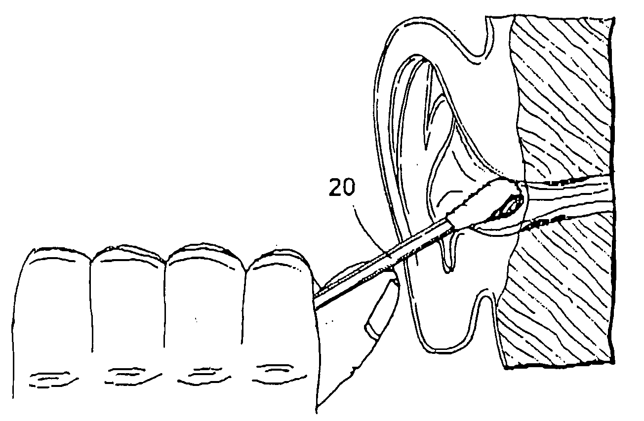 Method and apparatus for removal of cerumen