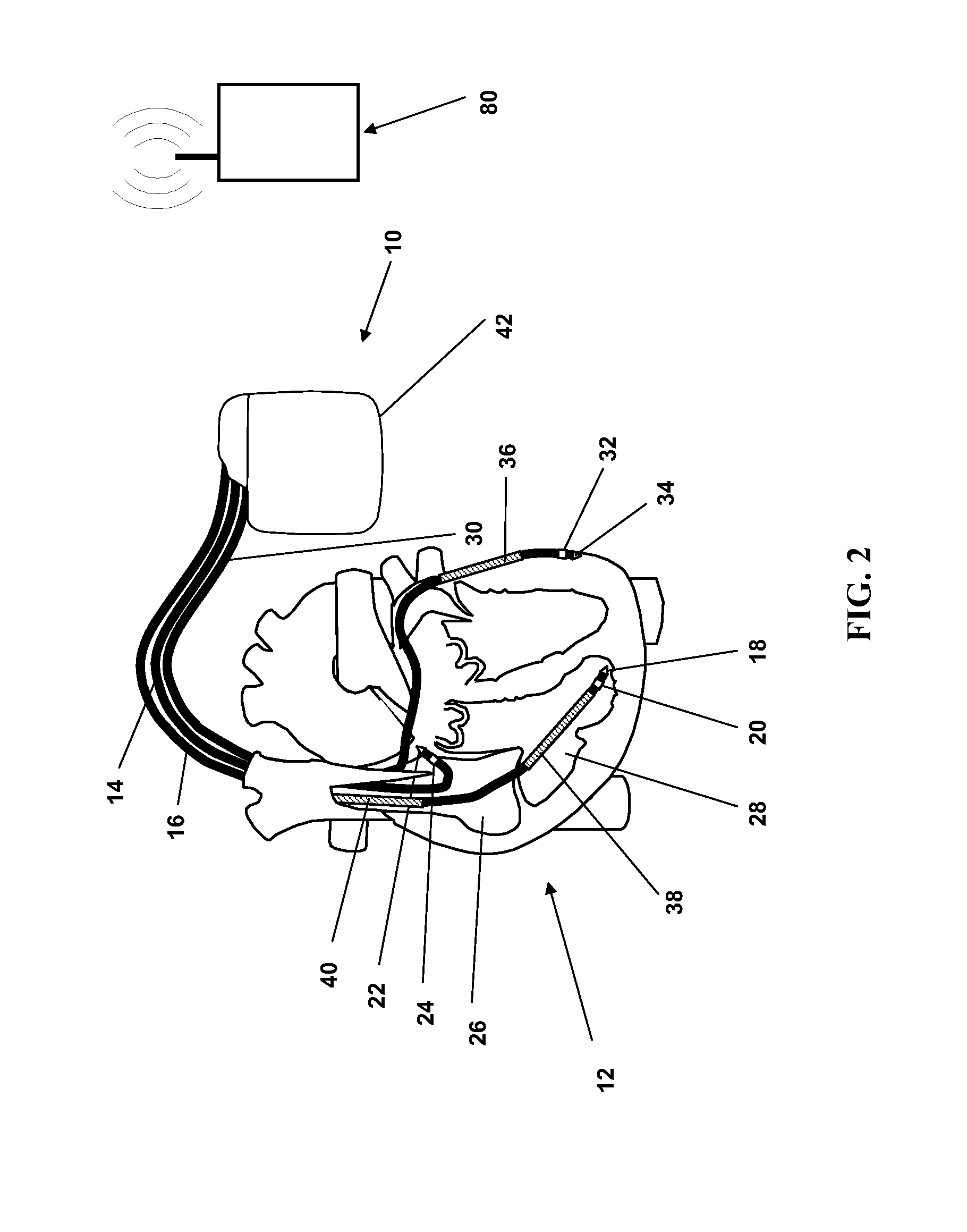 Heart monitoring apparatus