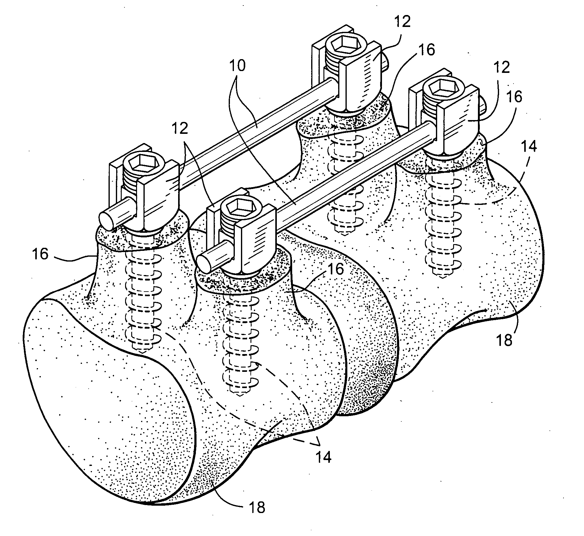 Apparatus and method for flexible spinal fixation