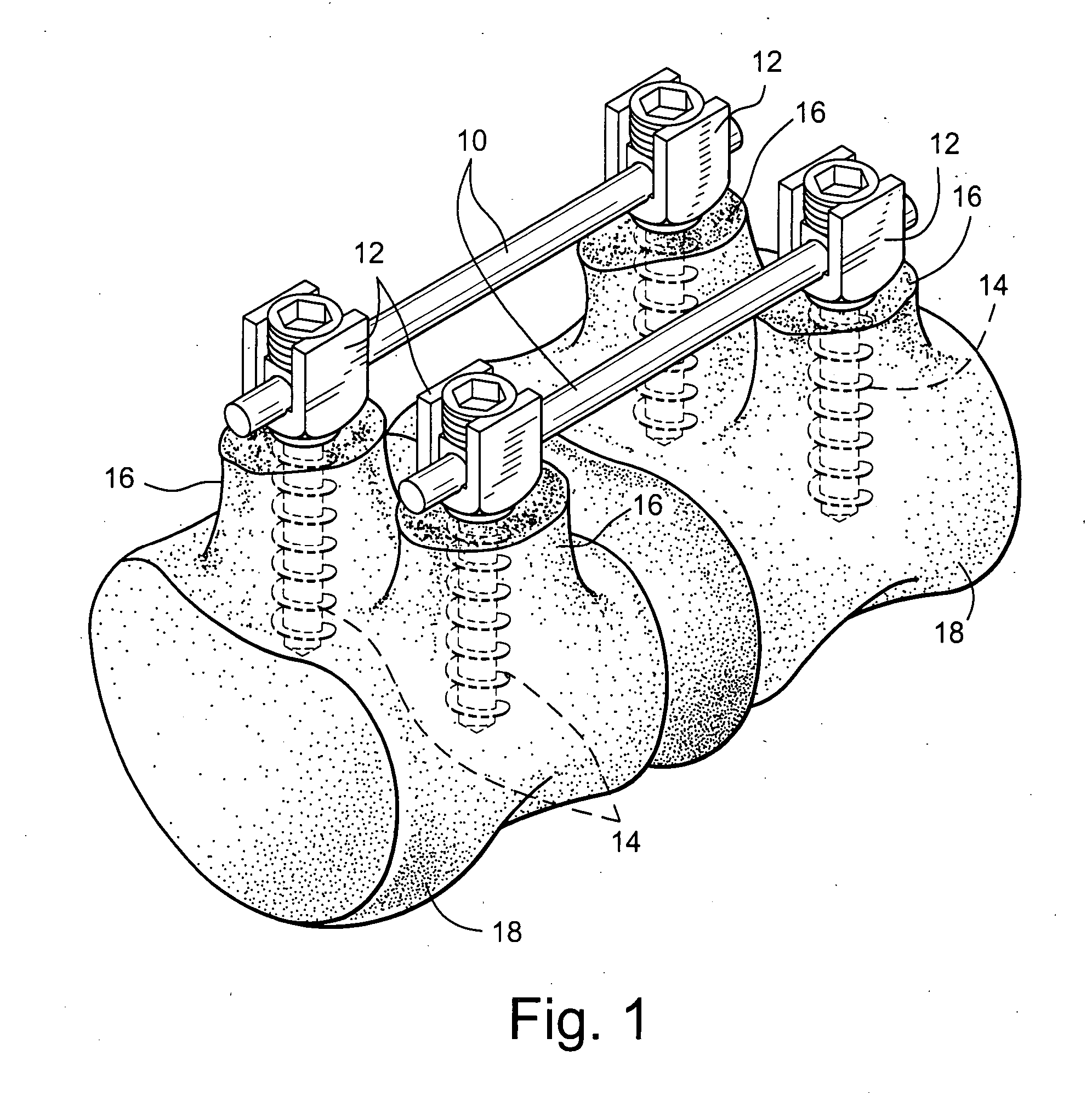 Apparatus and method for flexible spinal fixation