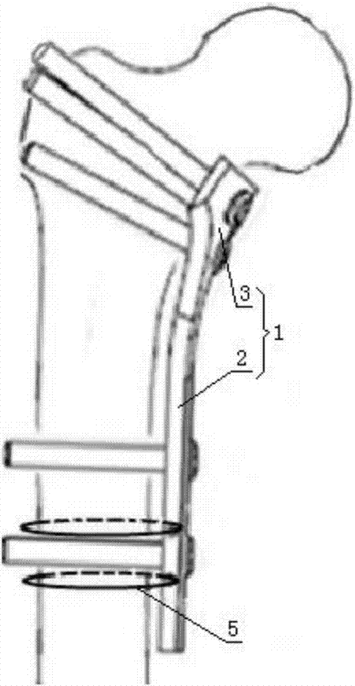 Fixation device for medial wall of femoral intertrochanteric fracture