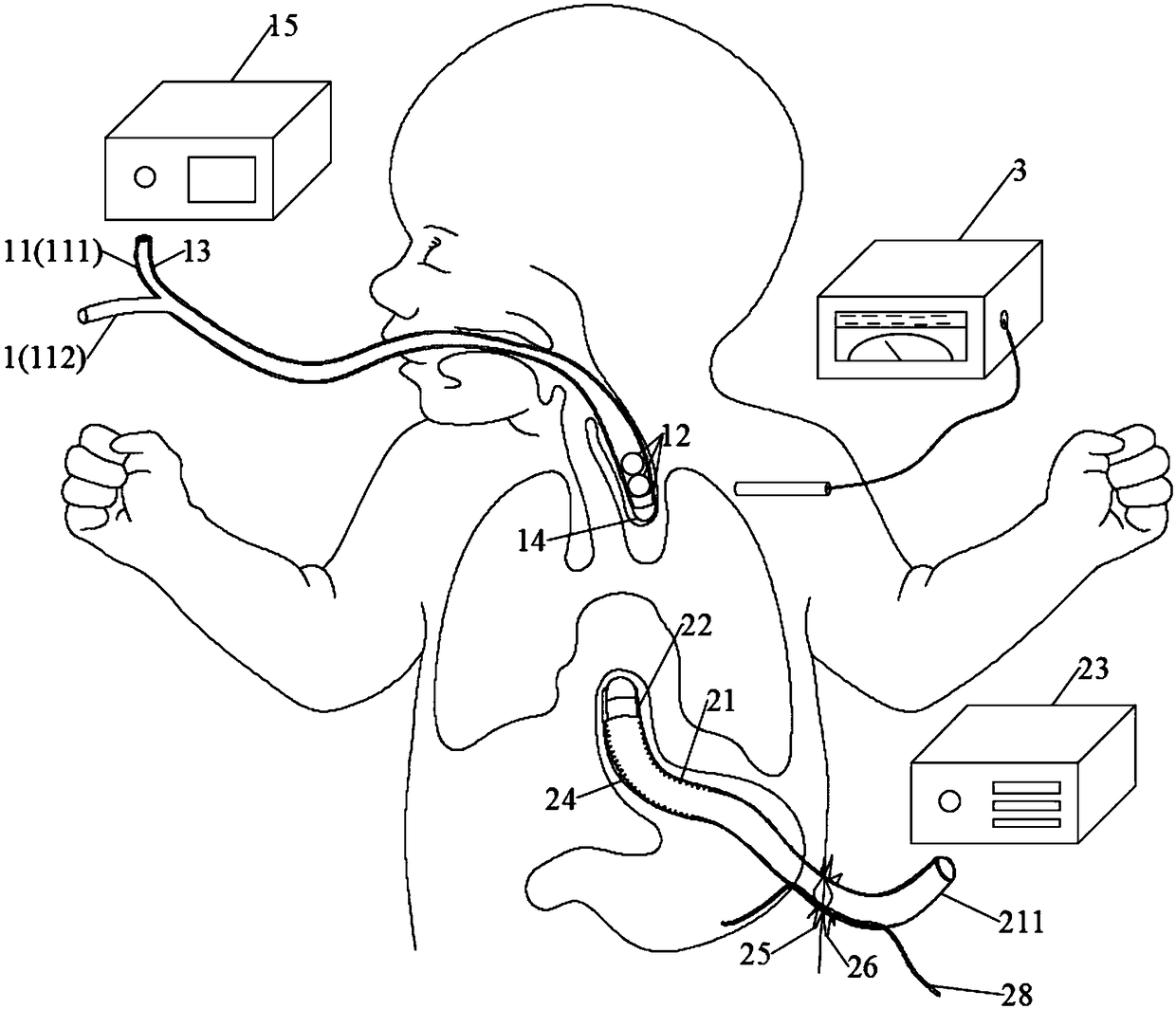 Medical equipment for congenital esophageal atresia and preparation method thereof