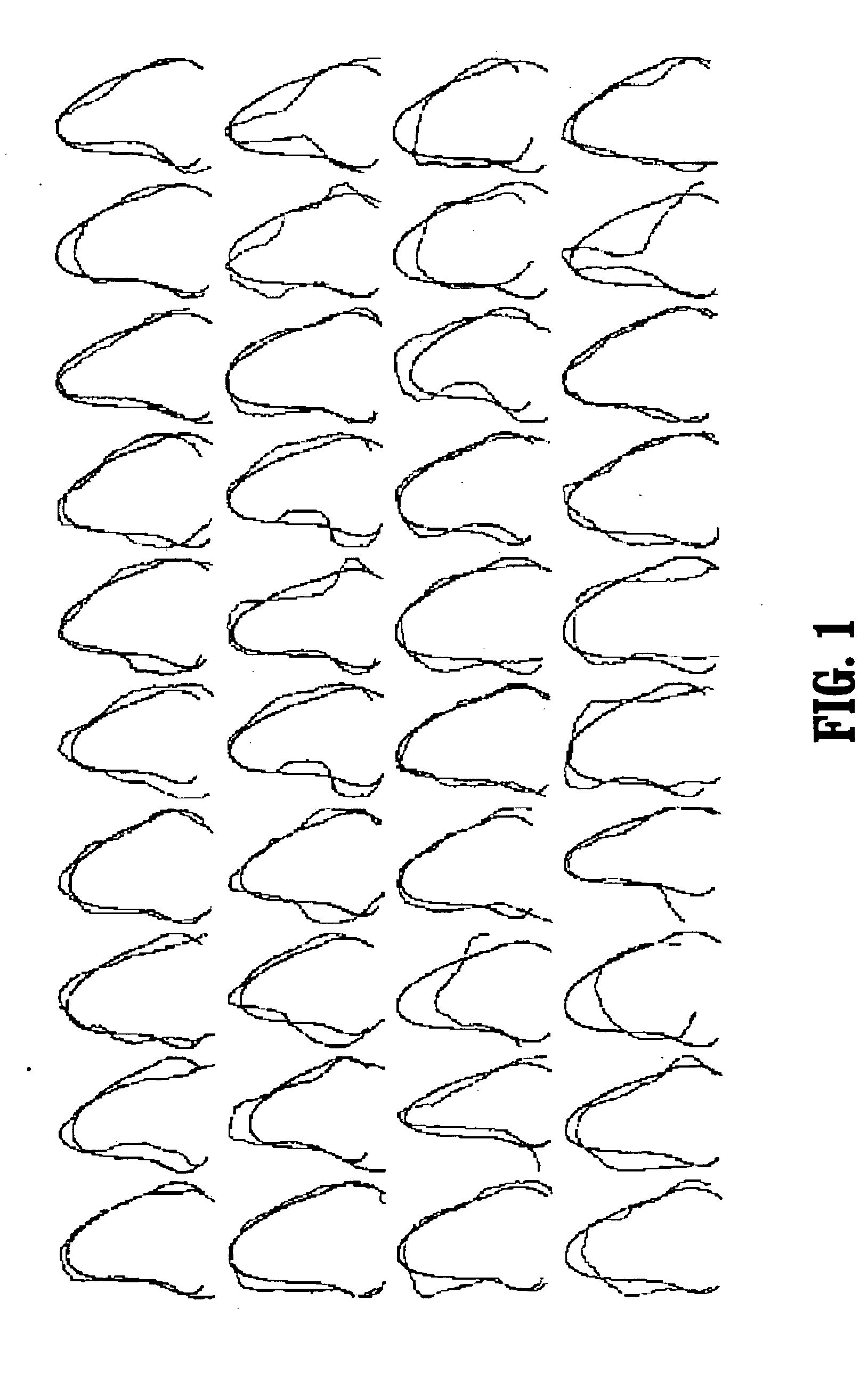 Segmentation of the left ventricle in apical echocardiographic views using a composite time-consistent active shape model