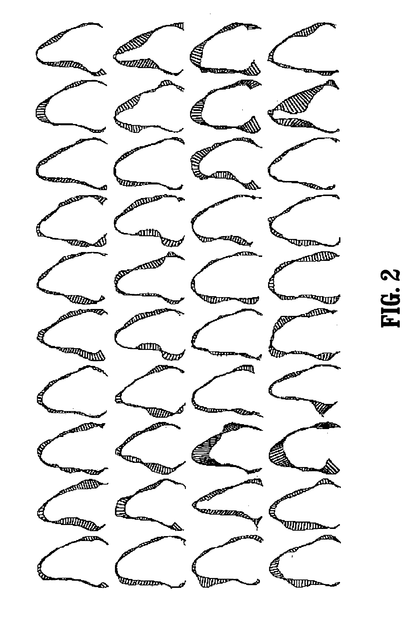 Segmentation of the left ventricle in apical echocardiographic views using a composite time-consistent active shape model