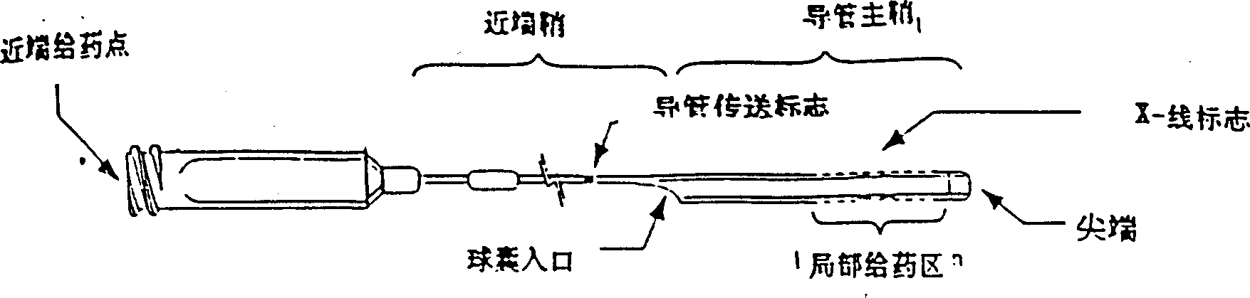 Method for quiding gene into local part or humanbody by shoe-type catheter