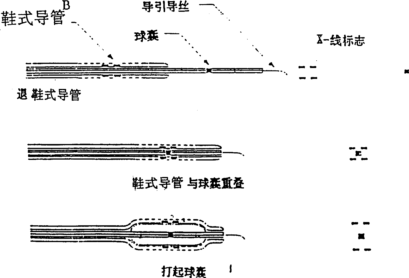 Method for quiding gene into local part or humanbody by shoe-type catheter