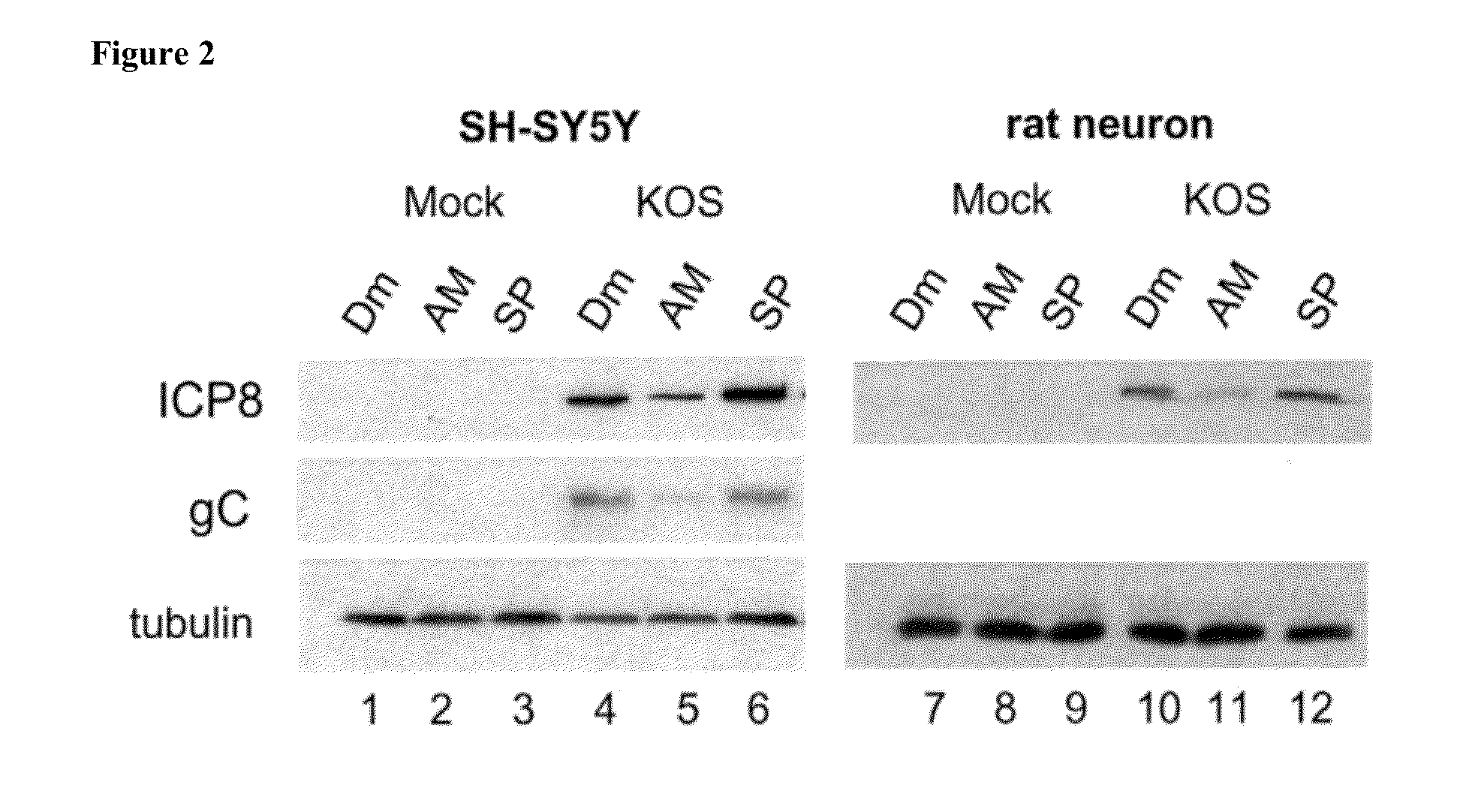 Pharmacologic treatments of meniére's disease