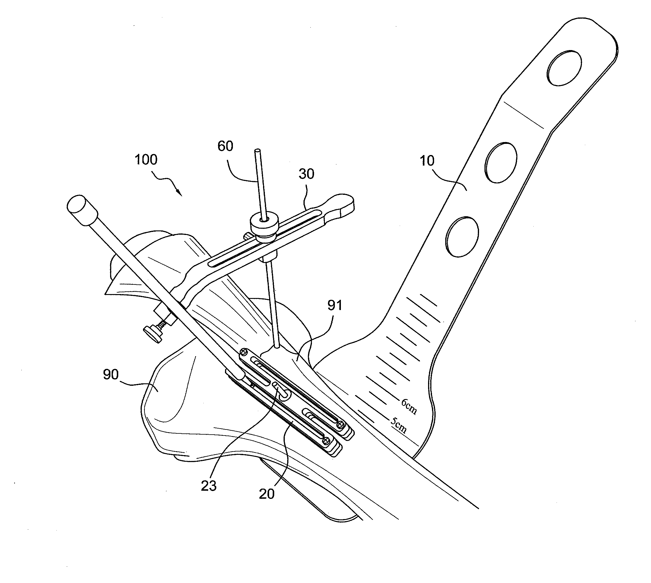 Amz tibial tuberosity transfer system