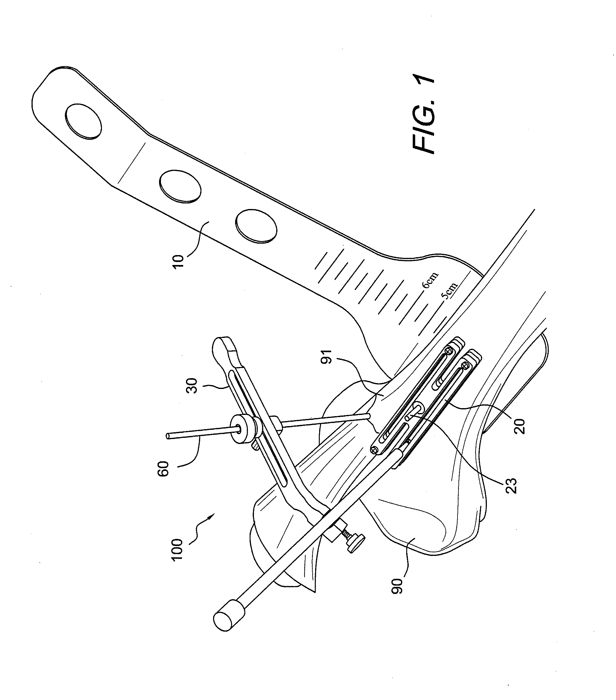 Amz tibial tuberosity transfer system