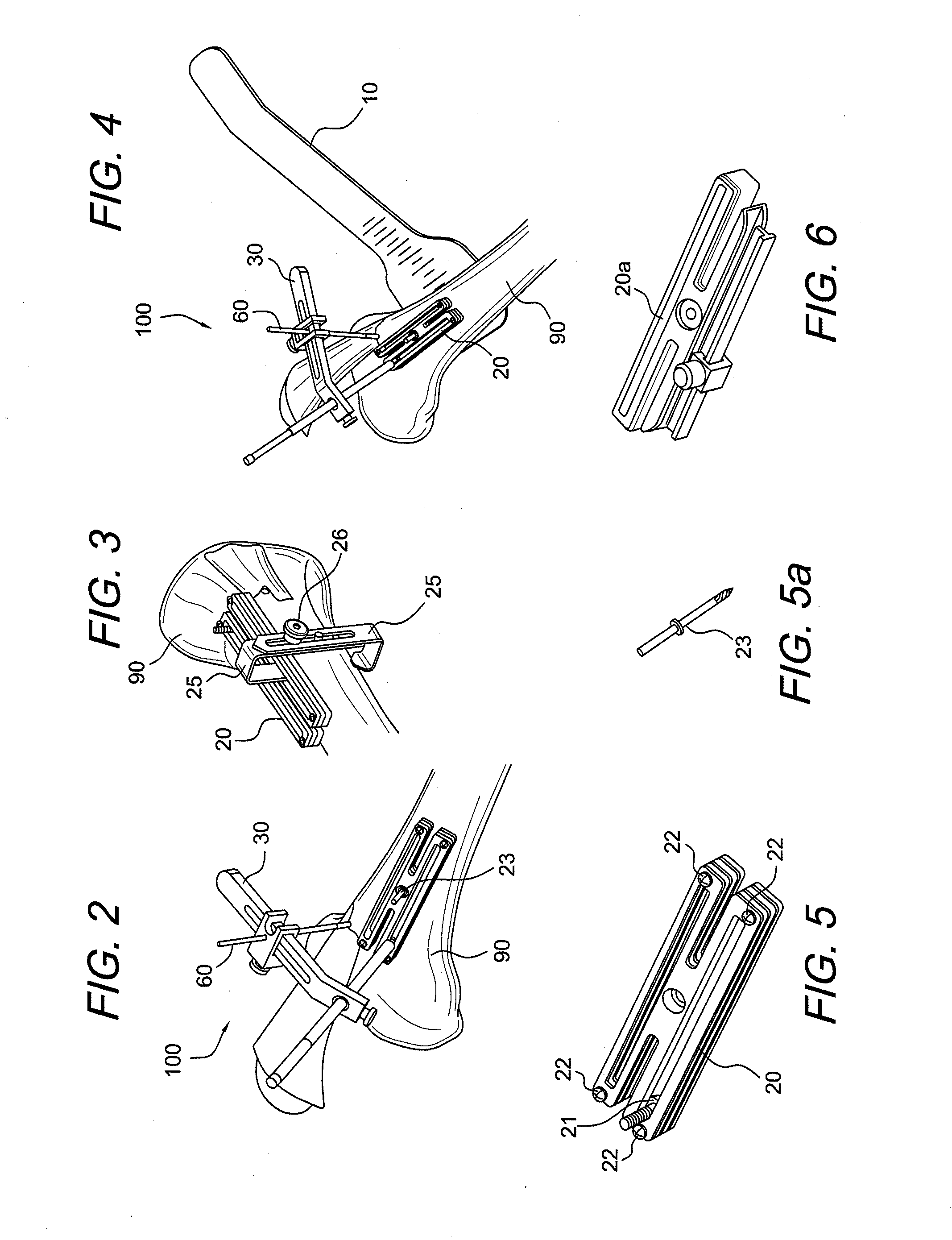 Amz tibial tuberosity transfer system