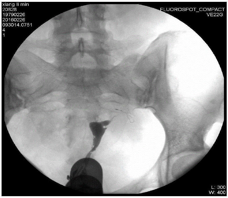 Improved operating method for hysterosalpinography