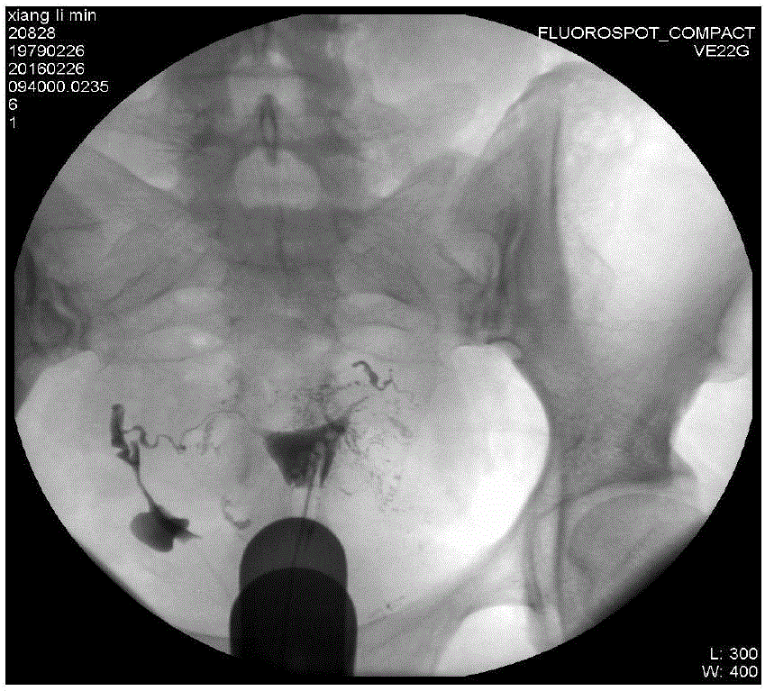 Improved operating method for hysterosalpinography