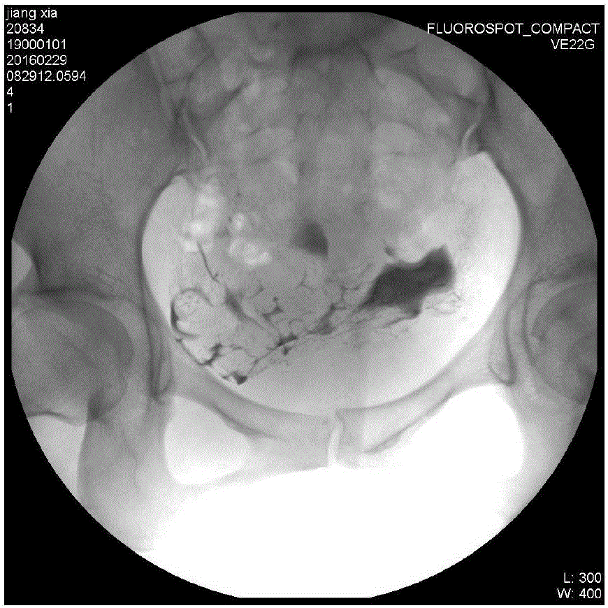 Improved operating method for hysterosalpinography