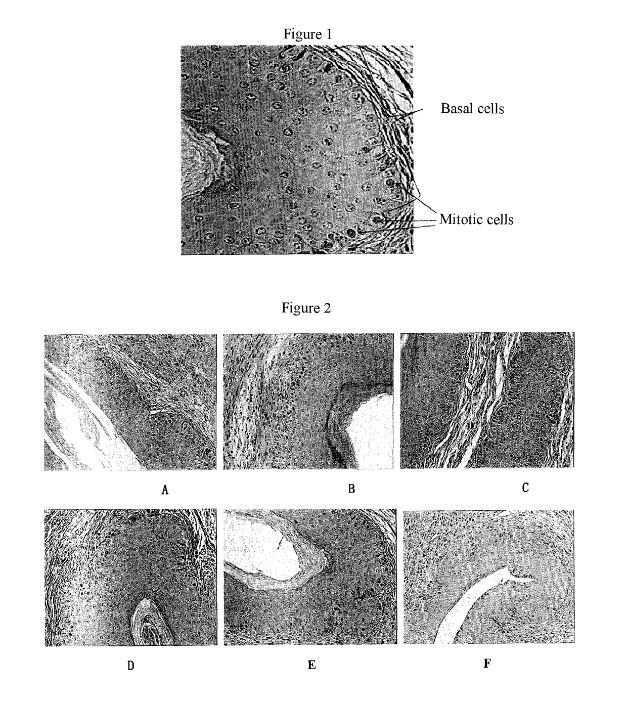 Use of α-(8-quinolinyloxy) mono-substituted phthalocyanine zinc for treatment of psoriasis