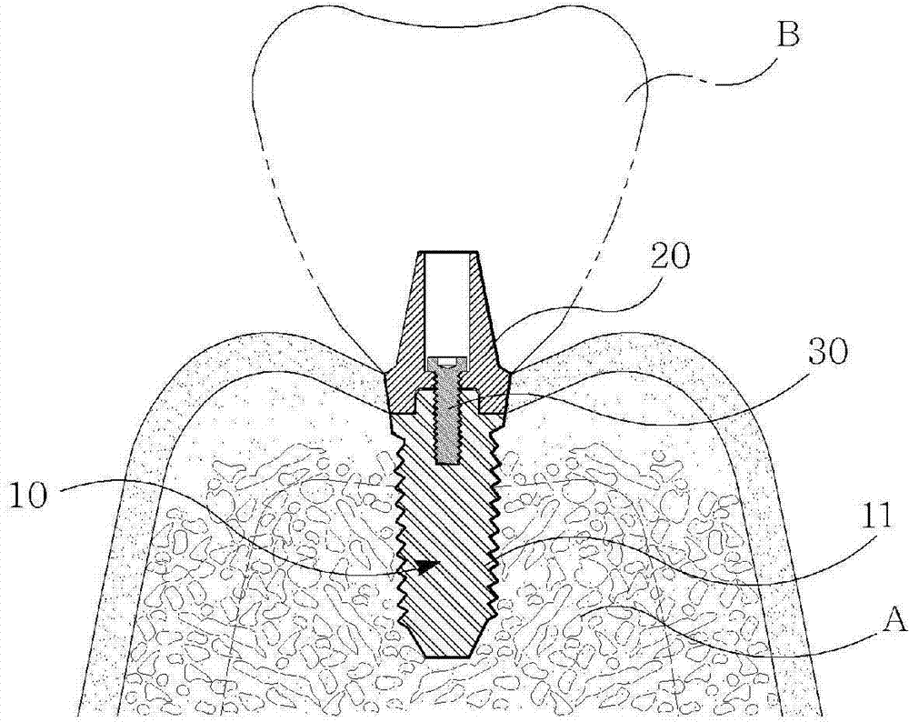 Dental implant