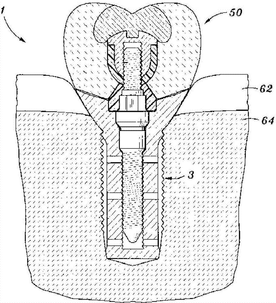 Dental implant