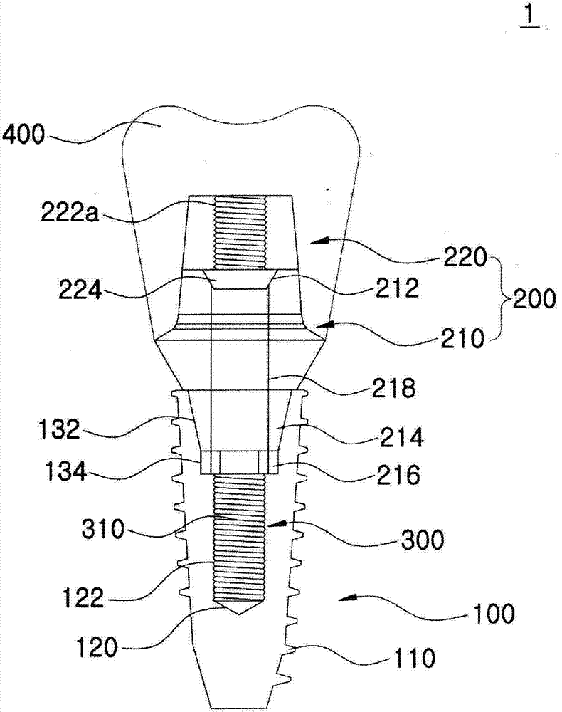 Dental implant