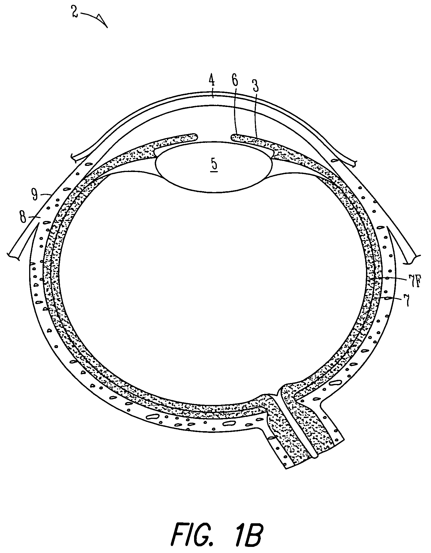 Insertion and extraction tools for lacrimal implants