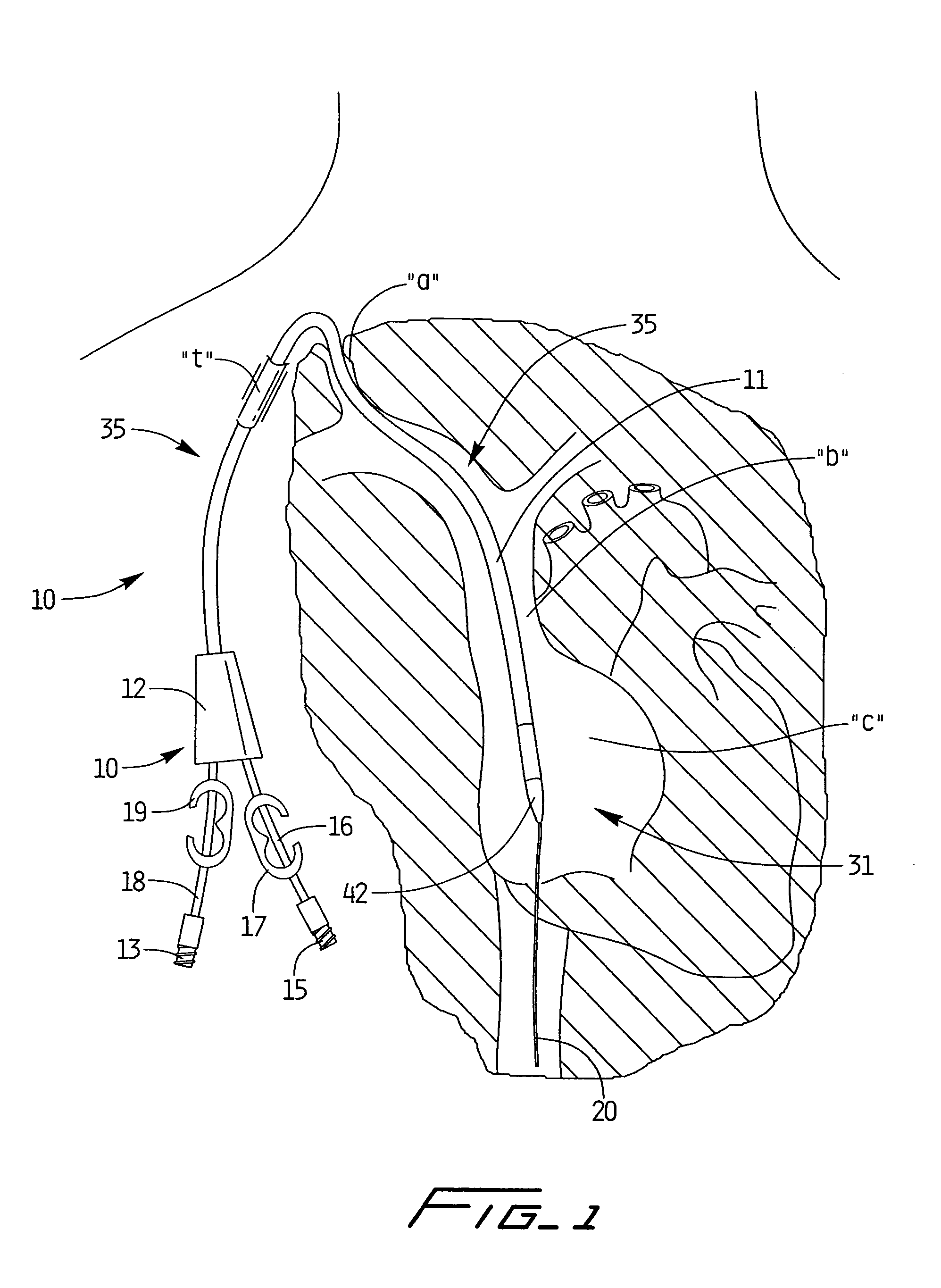 Dialysis catheter