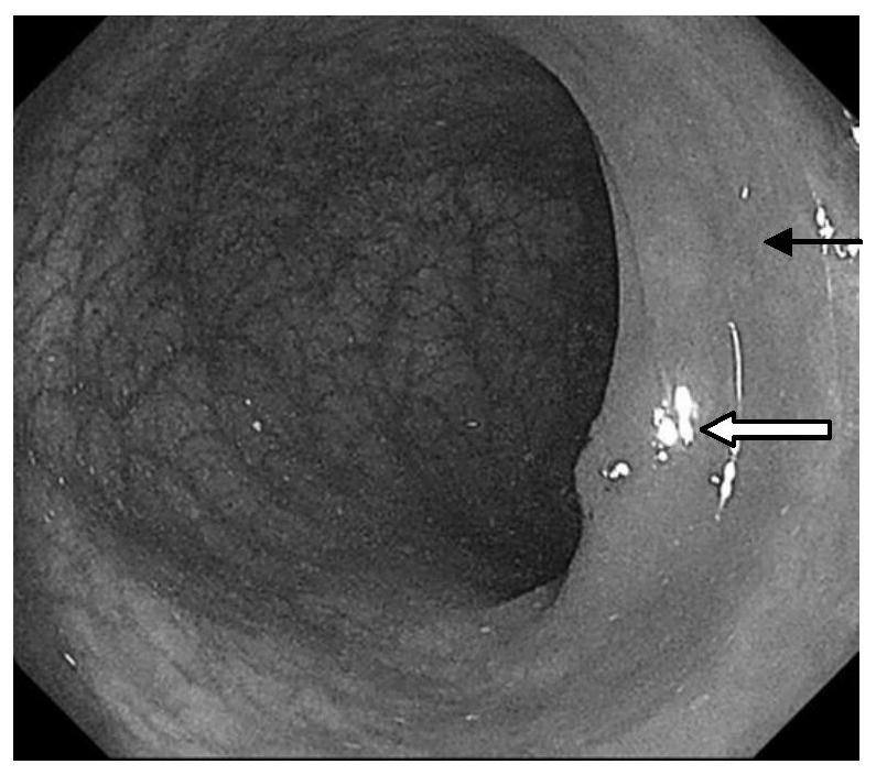 Application of Red Cabbage Pigment in Preparation of Endoscope Stain