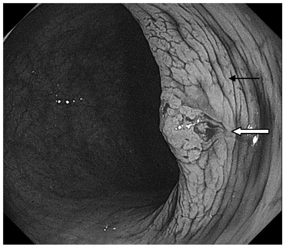 Application of Red Cabbage Pigment in Preparation of Endoscope Stain