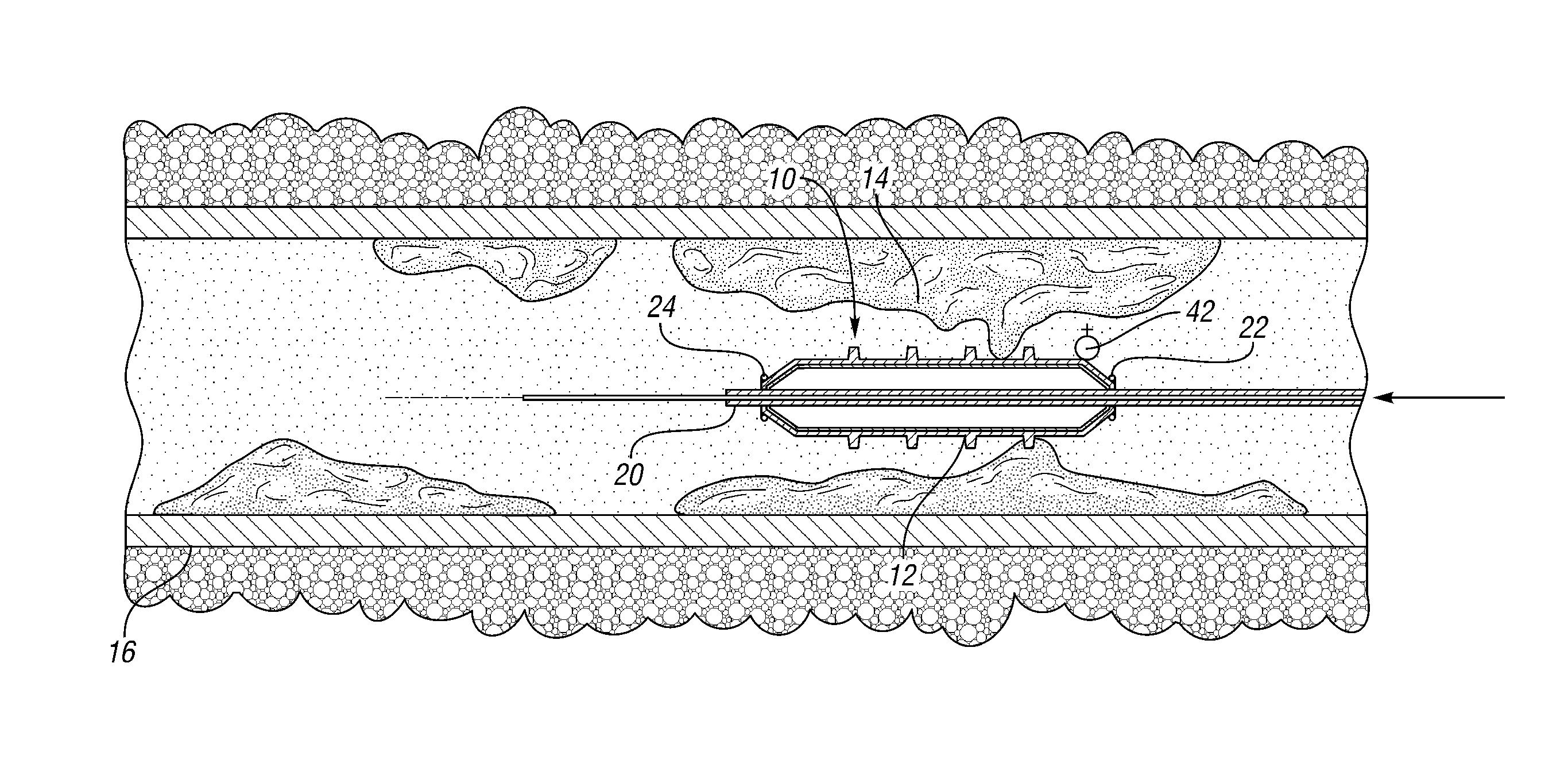 Catheter system with balloon-mounted plaque-modifying elements