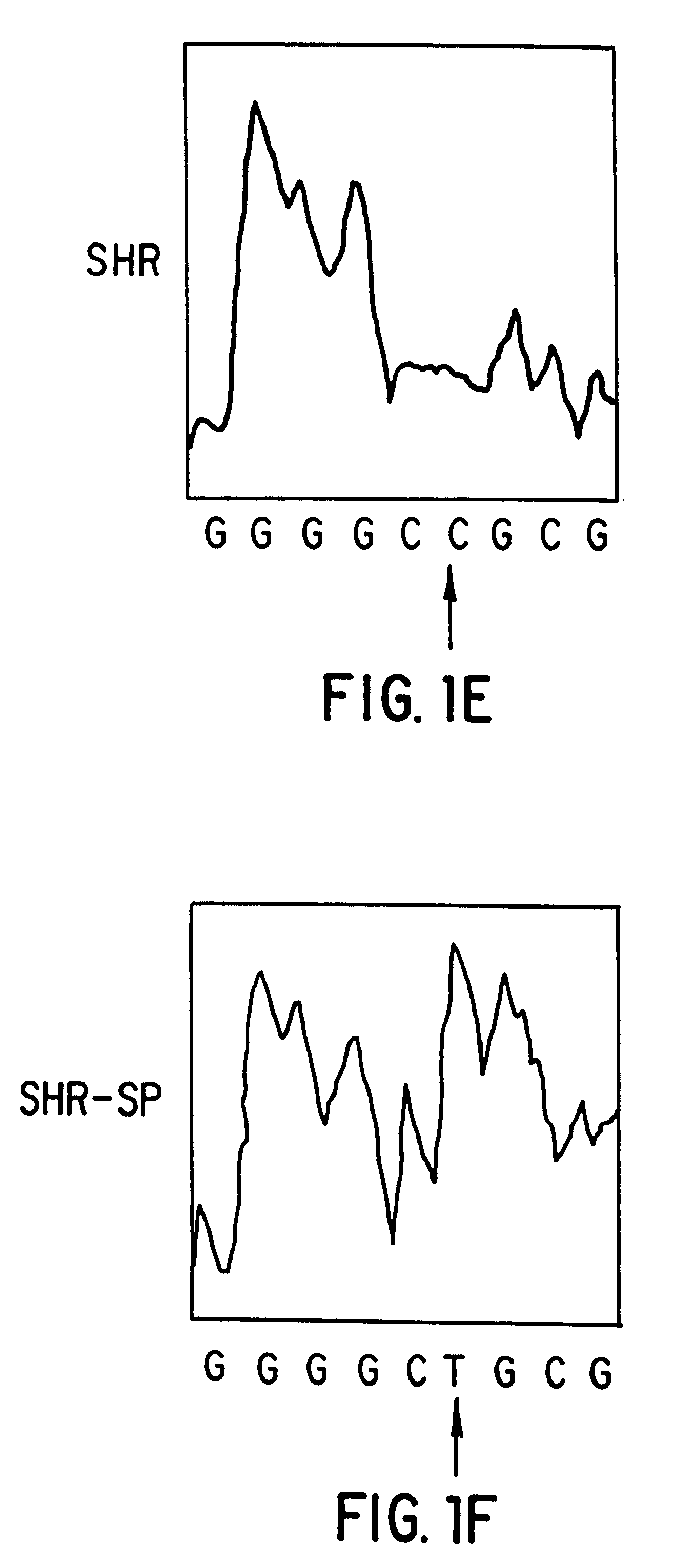 Atrial natriuretic factor mutants and ischemic stroke