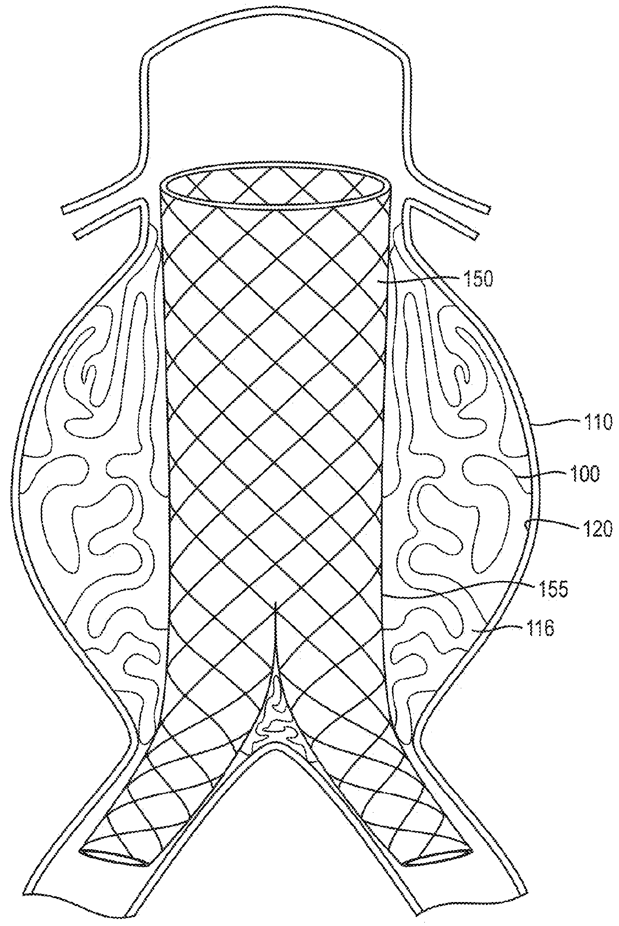 In-situ forming foams with outer layer