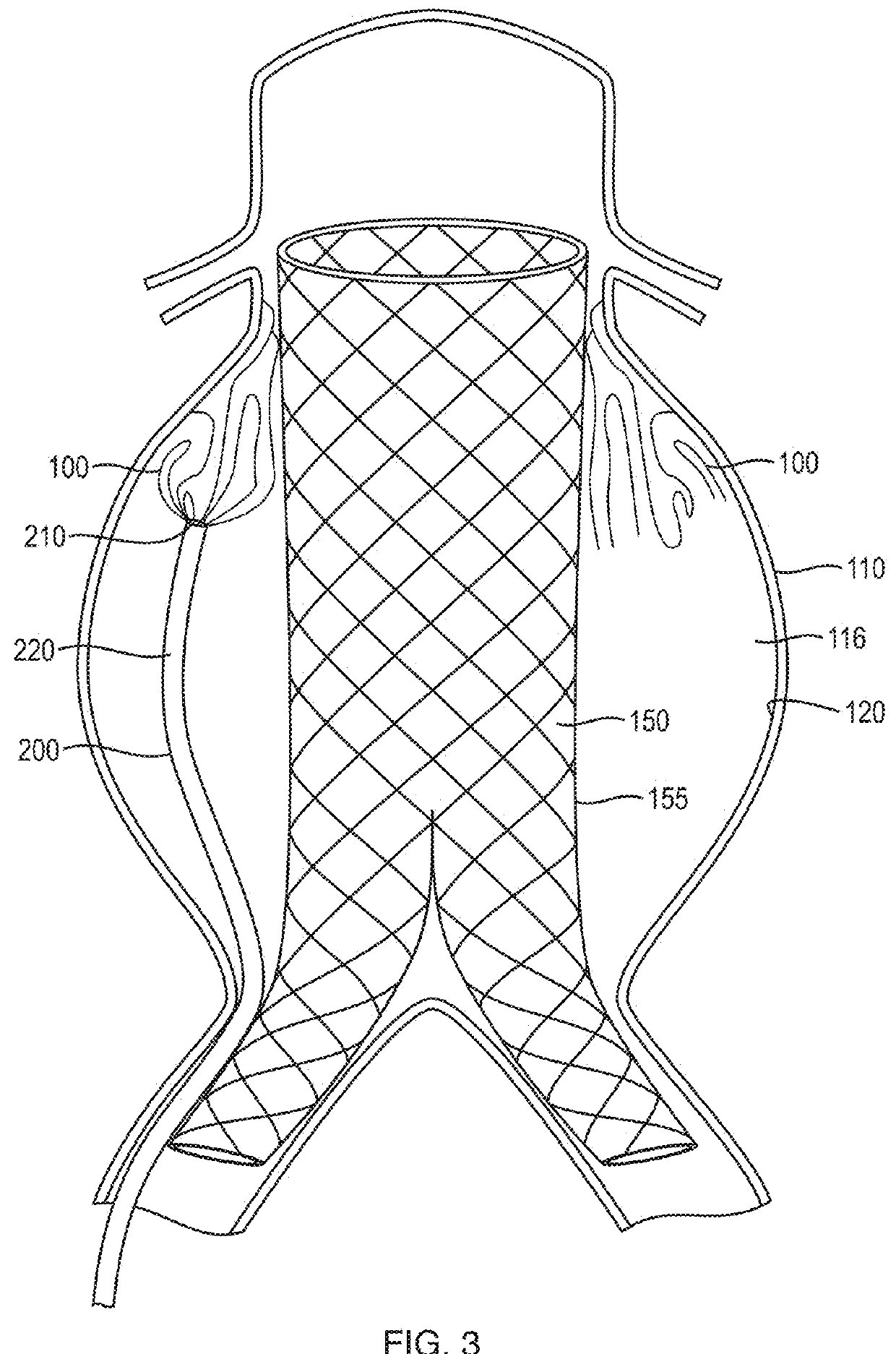 In-situ forming foams with outer layer