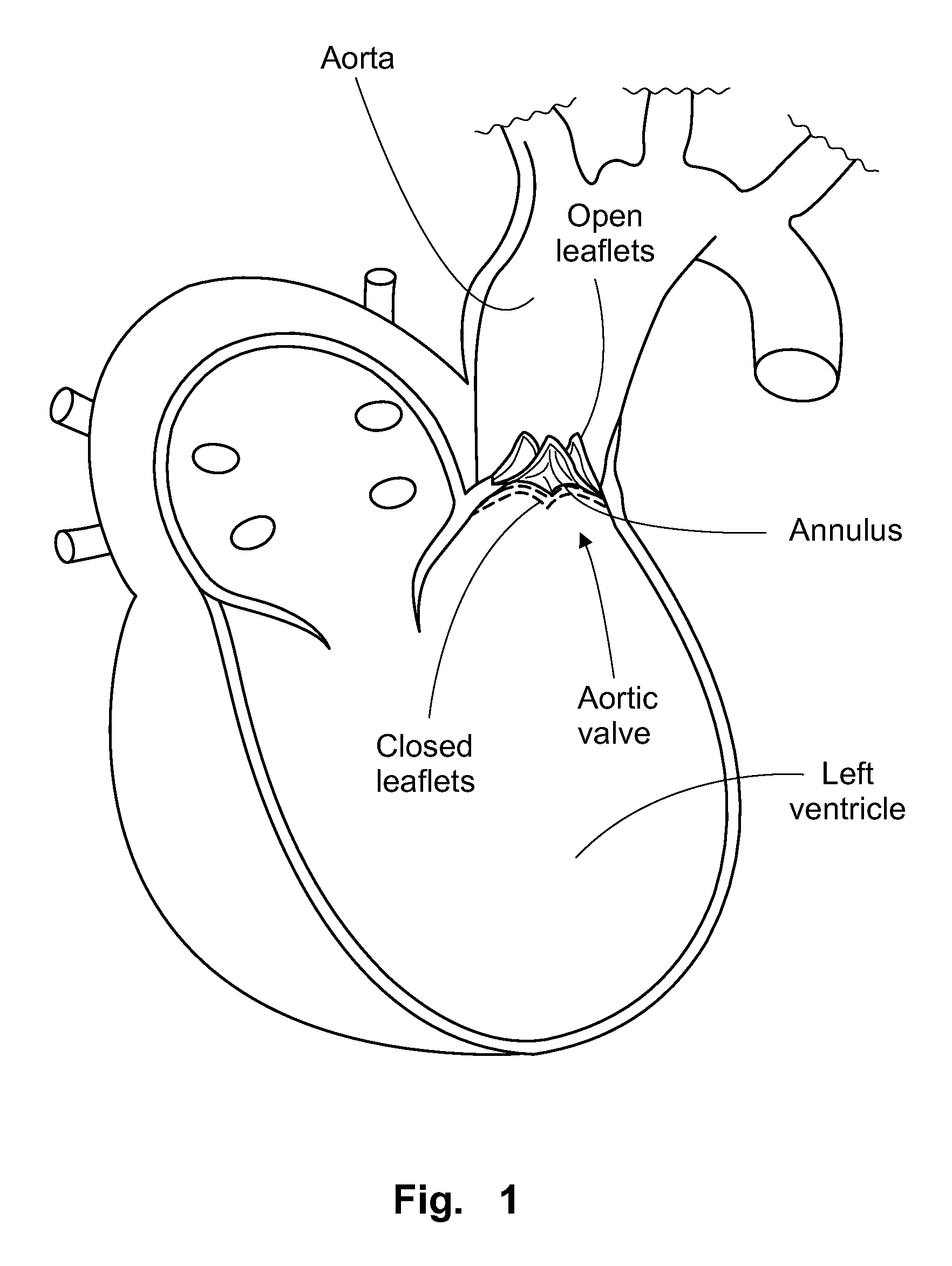 Prosthetic valve for intraluminal implantation